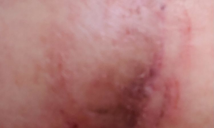 Rash y área roja después de levantamiento y aumento de senos - 67044