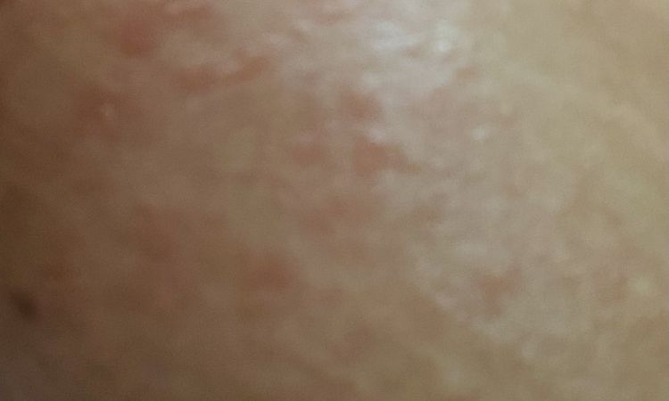 Rash y área roja después de levantamiento y aumento de senos - 67045