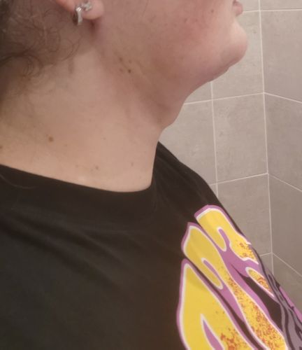 Inflamación lipo de papada