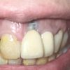 Consulta sobre implantes dentales - 68749