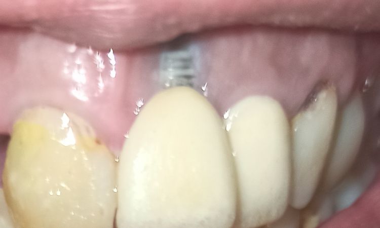 Consulta sobre implantes dentales - 68749