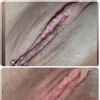 6 semanas despues de la labioplastia