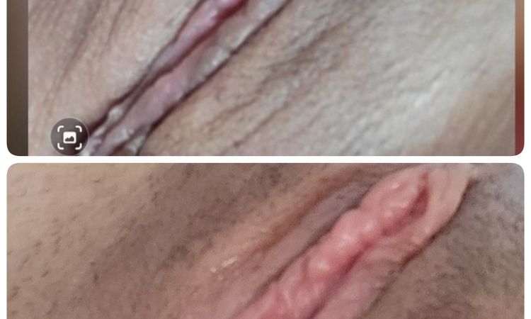 6 semanas despues de la labioplastia - 68971