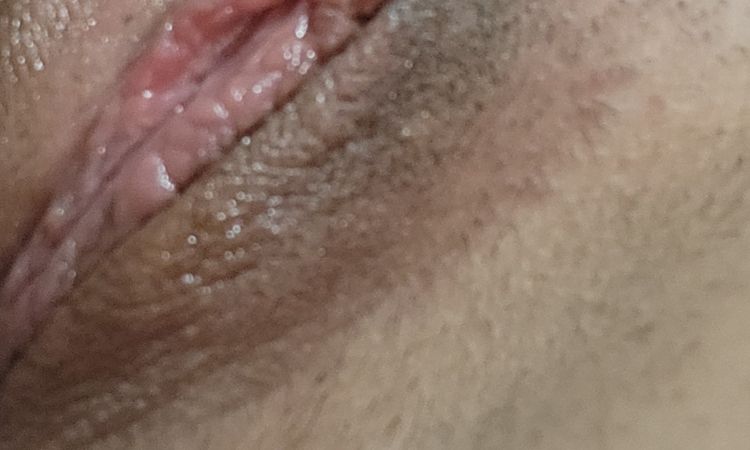 6 semanas despues de la labioplastia - 68972