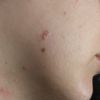 Verruga plana en rostro