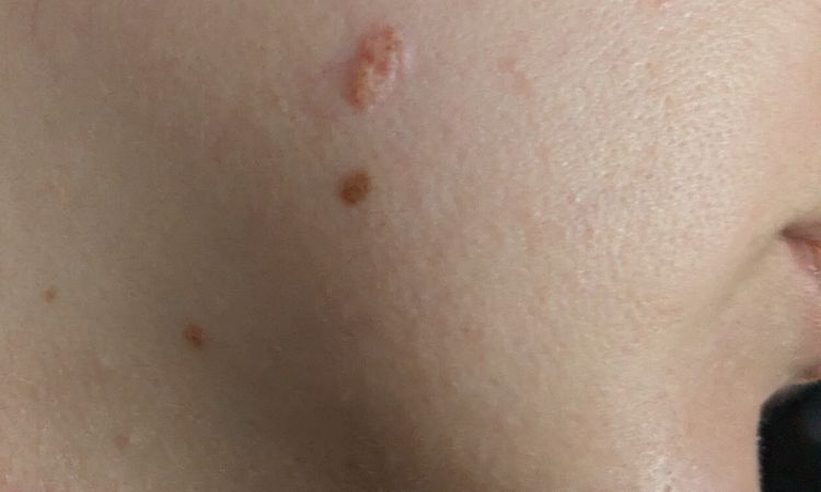 Verruga plana en rostro - 69046