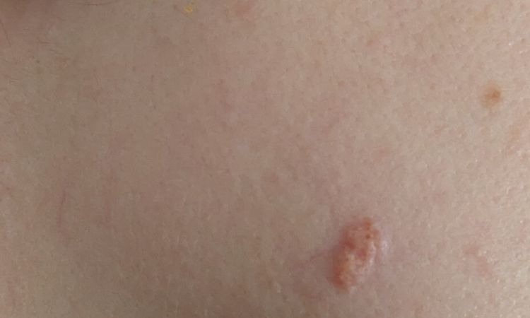Verruga plana en rostro - 69047
