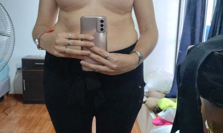 Operación mamaria para corregir asimetria - 69417