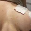 Ampollas en postoperatorio