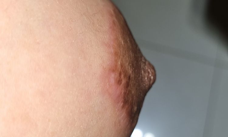 Fibrosis o queloide post mamplastia de aumento. 7 meses - 70938
