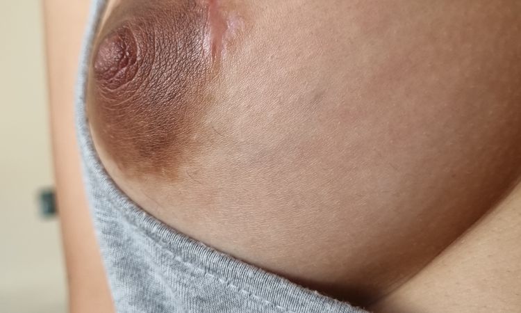Fibrosis o queloide post mamplastia de aumento. 7 meses - 70941