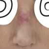 Adherencia de piel al dorso nasal