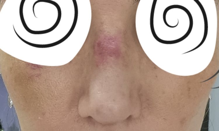 Adherencia de piel al dorso nasal - 71032