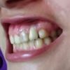 Implante dental quedó muy largo - 71798
