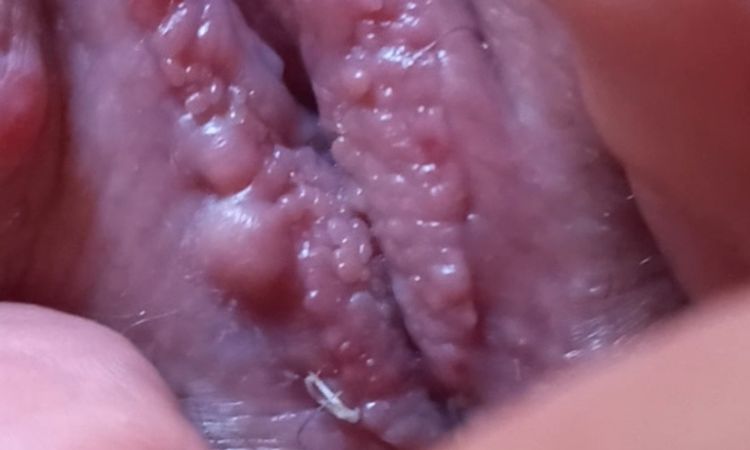 Labioplastia casi un mes - 74363