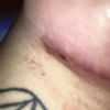 Pequeño seroma mama derecha