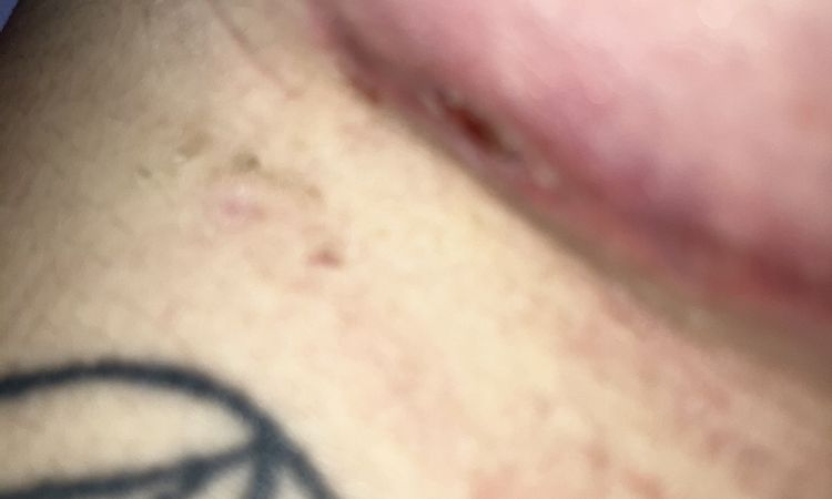 Pequeño seroma mama derecha - 74371
