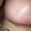 Pequeño seroma mama derecha