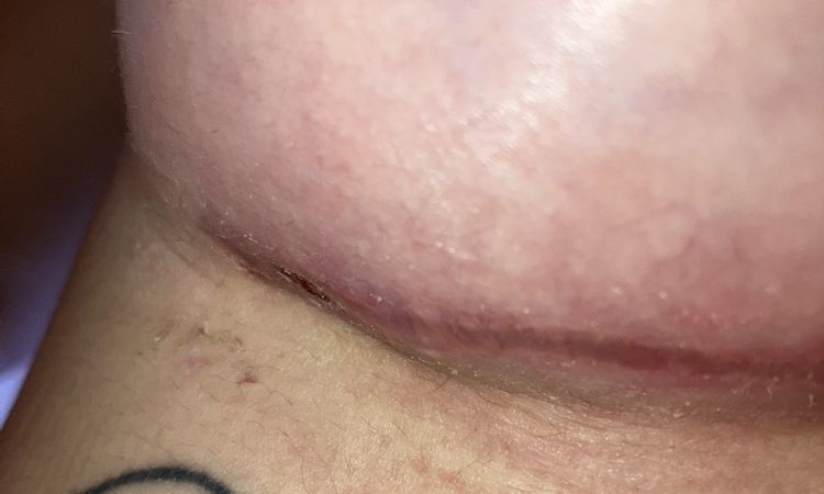 Pequeño seroma mama derecha - 74372