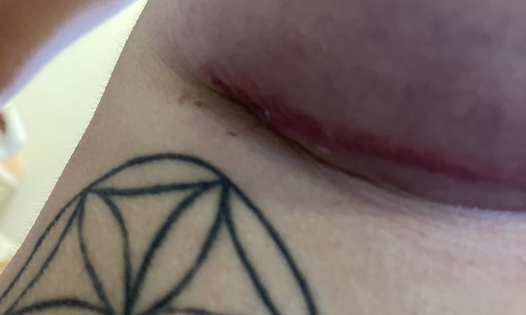Herida muy roja despues de 1 mes - 74814