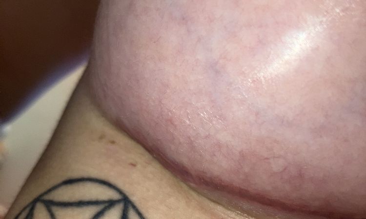 Herida muy roja despues de 1 mes - 74815