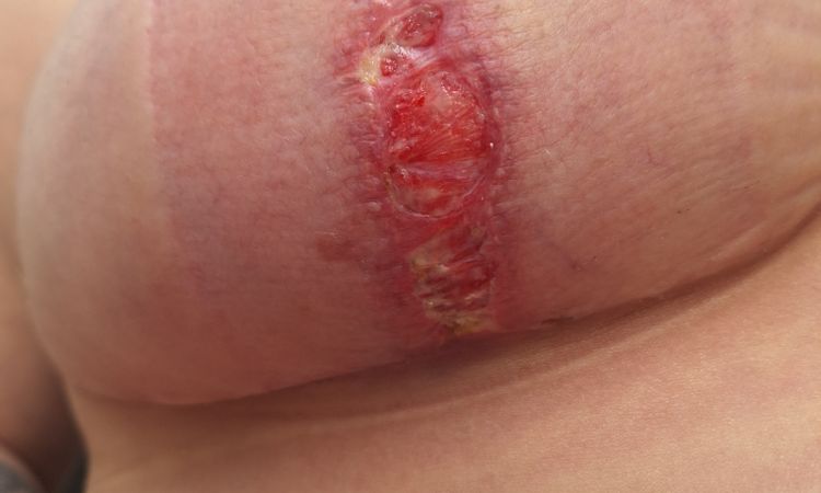 Mastopexia sin implantes - puntos abiertos - 79062