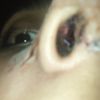 Se abrió un punto en mi rinoplastia