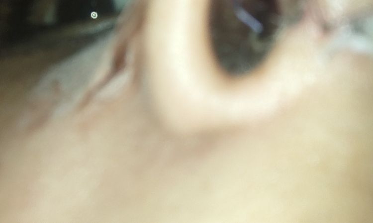 Se abrió un punto en mi rinoplastia - 81324