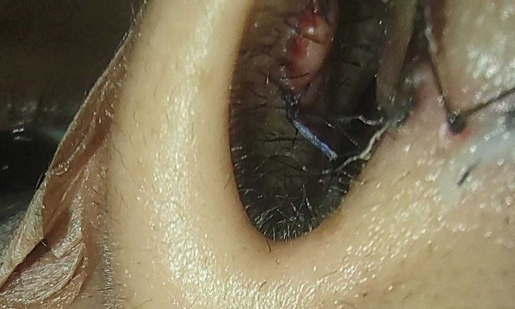 Se abrió un punto en mi rinoplastia - 81325