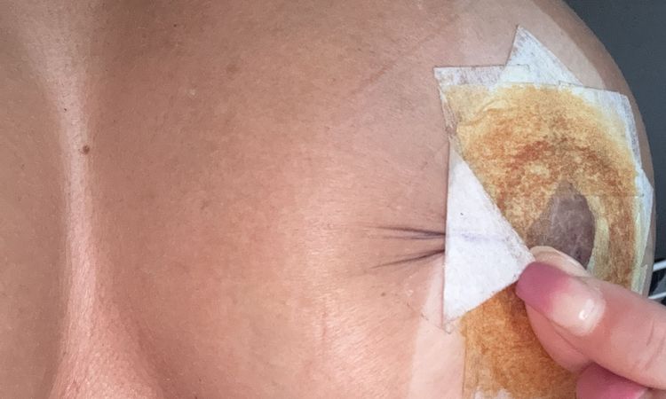 Pliegues tras cirugía periareolar se quitan - 81456