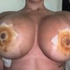 Pliegues tras cirugía periareolar se quitan