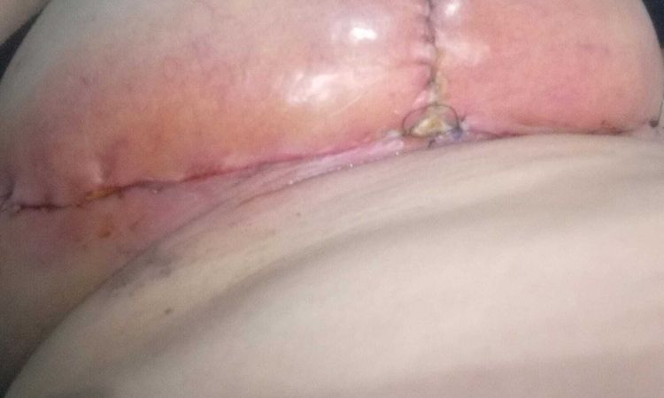 Seroma después de 5 días de mastopexia más implante - 81465