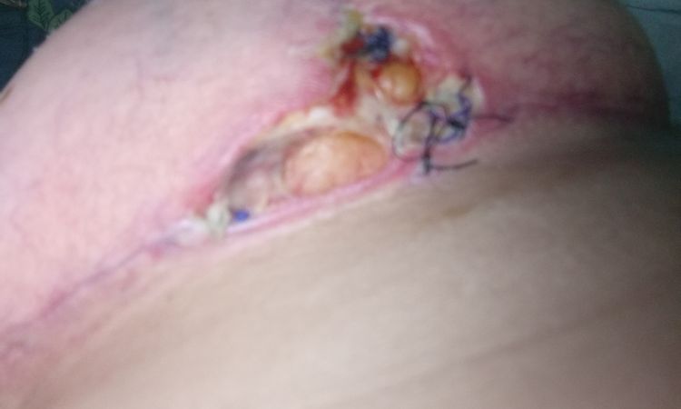 Se me sigue abriendo la herida de mastopexia con implantes luego de un mes. - 81679