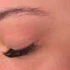 Remover verruga pequeña cerca del ojo