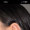 Pliegue concha otoplastia