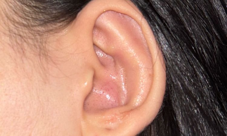 Pliegue concha otoplastia - 82051