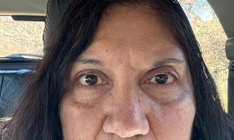 ¿Cuánto tiempo hay que esperar para corregir una cirugía de párpados? - 82225