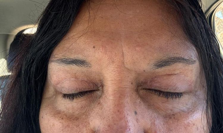 ¿Cuánto tiempo hay que esperar para corregir una cirugía de párpados? - 82226