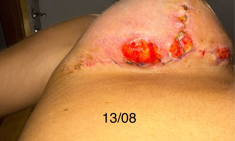 Puntos abiertos y heridas abiertas a peor - 82391