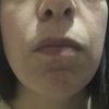 Lipoaspiración facial