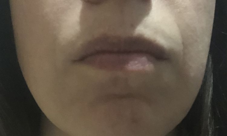 Lipoaspiración facial - 82877