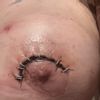 Cirugía con implantes a los 7 días me sangró un punto