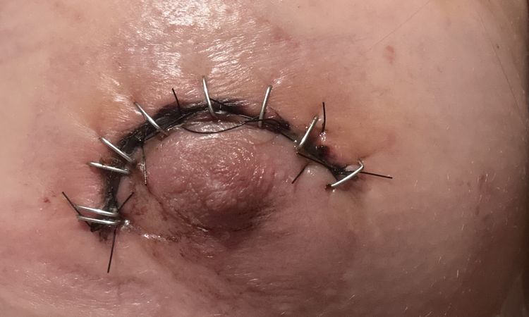Cirugía con implantes a los 7 días me sangró un punto - 82905