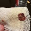 Cirugía con implantes a los 7 días me sangró un punto