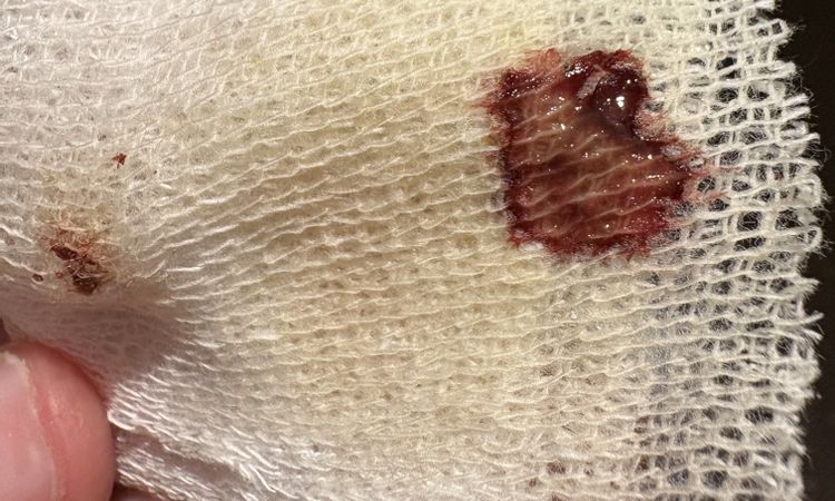 Cirugía con implantes a los 7 días me sangró un punto - 82907