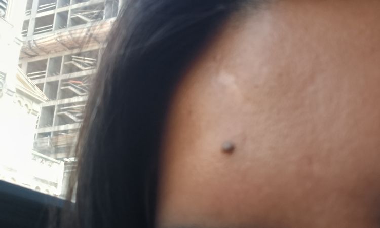 Cicatrices atroficas - 83268