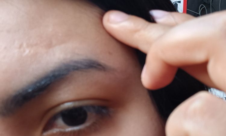 Cicatrices atroficas - 83269