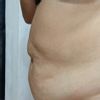 Tratamiento abdomen colgante y abultado