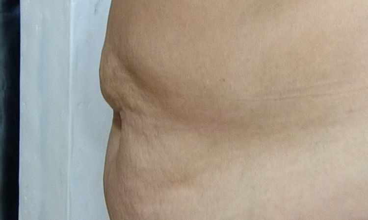 Tratamiento abdomen colgante y abultado - 83585