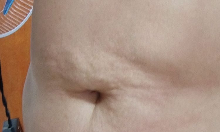 Tratamiento abdomen colgante y abultado - 83586